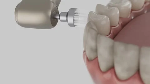 Teeth polishing 動画素材 315028376