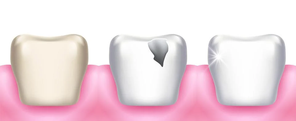 Teeth problems. Tooth decay, dental diseases, infection caries and enamel Stock Illustration