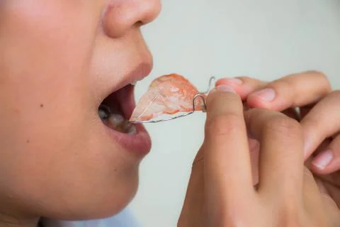 Teeth with retainer Stock Photos