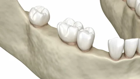 Teeth shift deformatiuon after losing teeth Stock Footage 140628490