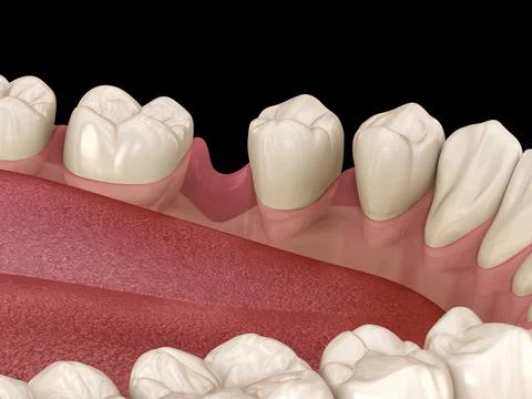Teeth shift deformatiuon after losing molar tooth. 3D illustration of Popov G Stock Illustration