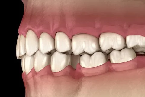 Teeth shift deformatiuon after losing molar tooth. 3D illustration of Popov G Stock Illustration