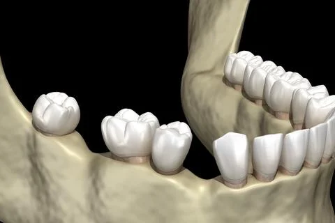 Teeth shift deformatiuon after losing teeth. 3D illustration Stock Illustration