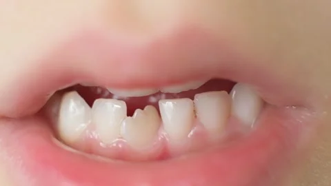The teeth of a six-year-old child, a crookedly growing incisor in place of a Stock Footage 252930114