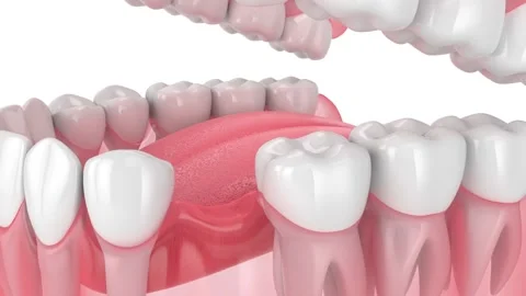 Teeth sliding towards the area of missing tooth. 스톡 동영상 138614216