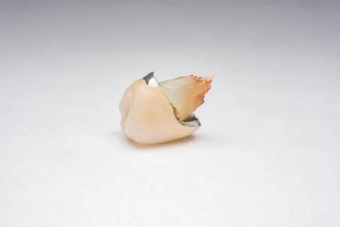 Teeth, tooth, Caries, decayed tooth Stock Photos