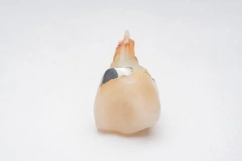 Teeth, tooth, Caries, decayed tooth Stock Photos
