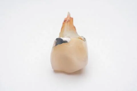 Teeth, tooth, Caries, decayed tooth Stock Photos