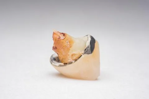 Teeth, tooth, Caries, decayed tooth Stock Photos