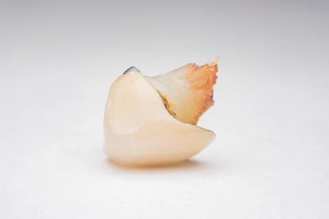 Teeth, tooth, Caries, decayed tooth Stock Photos