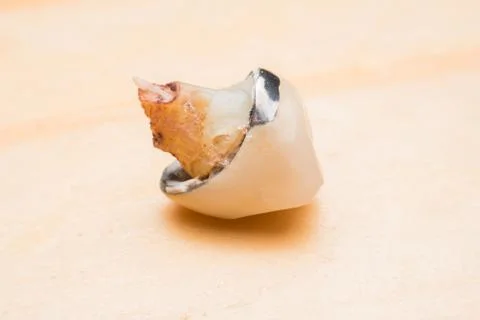 Teeth, tooth, Caries, decayed tooth Stock Photos