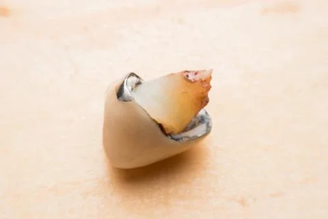 Teeth, tooth, Caries, decayed tooth Stock Photos