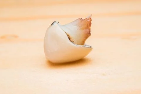 Teeth, tooth, Caries, decayed tooth Stock Photos