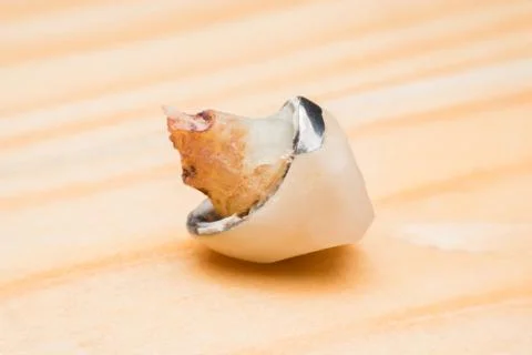 Teeth, tooth, Caries, decayed tooth Stock Photos