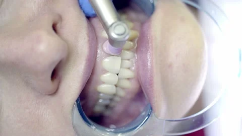 Teeth whitening in the clinic Stock Footage