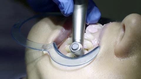 Teeth whitening at the dentist Stock Footage 149262559