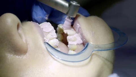 Teeth whitening at the dentist Stock Footage 149262567