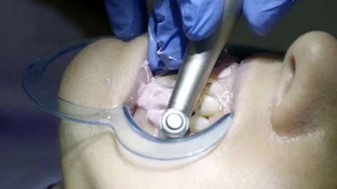 Teeth whitening at the dentist Stock Footage 149262582