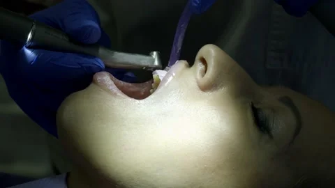 Teeth whitening at the dentist Stock Footage 149262587