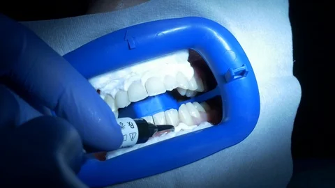 Teeth whitening Video stock 96500393