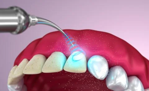 Teeth whitening , Medically accurate 3D illustration Stock Illustration
