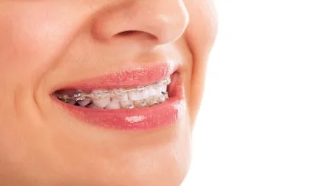 Teeth whitening Stock-Fotos