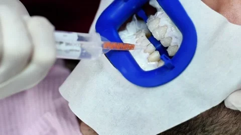 Teeth whitening procedure at dentist. Video stock 288988963