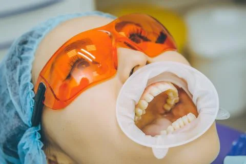 Teeth whitening procedure Stock Photos