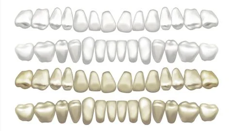 Teeth Whitening Vector. Before And After. Tooth Veneer Whitening. Isolated Illustrazione stock