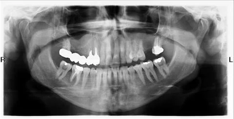 Teeth on x-ray image Stockfoto's