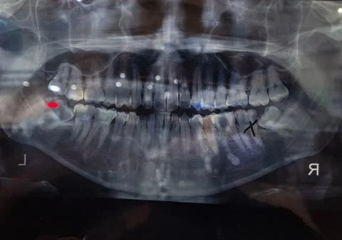 Teeth X-Ray Stock Photos
