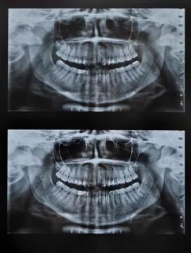 Teeth xray of full face Foto stock