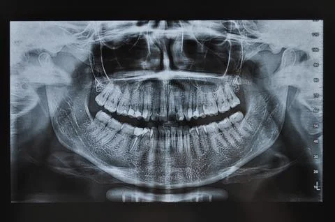Teeth xray of full face Stock Photos