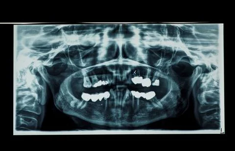 Teeth xray imagery Foto stock