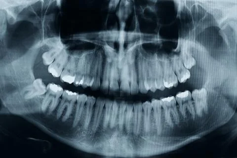 Teeth xray Stock-Fotos