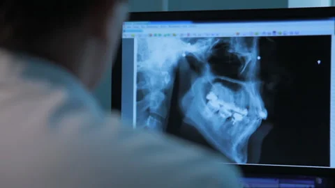 Temporomandibular joint dysfunction.TMJD or TMD. Stock Footage 130758231