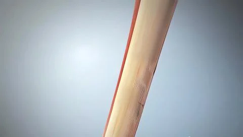 Tendon rupture is a long partial or complete tear of the tendon Stock Illustration