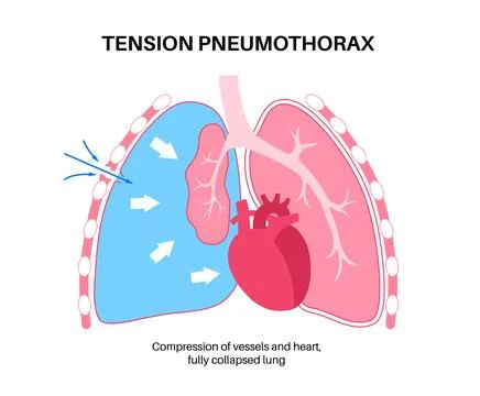 Tension pneumothorax poster Stock Illustration