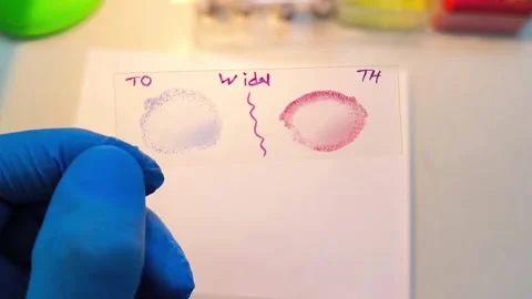 Test for Salmonella typhi and salmonella parratyphi Video stock 337723758