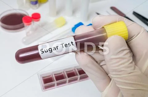 Test Tube With Blood For Sugar Test For Diabetic Patient.