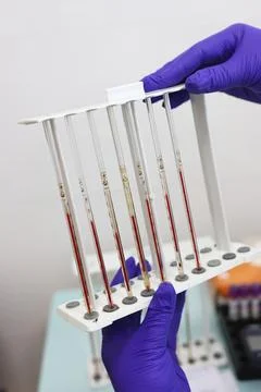 Test tubes with blood samples for analysis. Diagnostics and blood tests. Foto stock