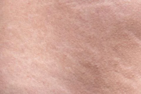 Texture of human's body with the stretch marks, closeup photo Stock Photos