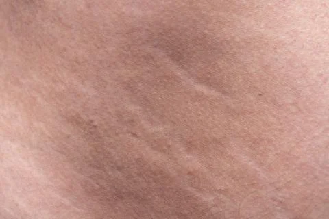 Texture of human's derma with the stretch marks, closeup photo Stock Photos