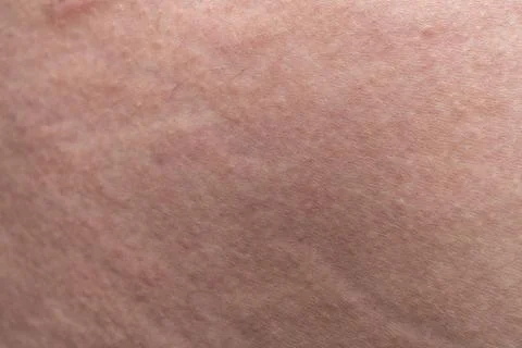 Texture of human's skin with the stretch marks, closeup photo Stock Photos