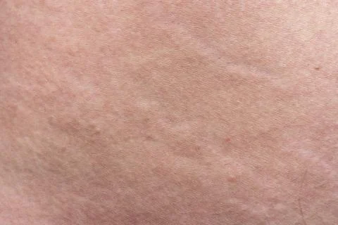 Texture of man's skin with the stretch marks, closeup photo Stock Photos