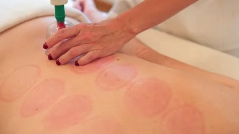 Therapist hands working on vacuum cupping massage. Stock Footage 255129267