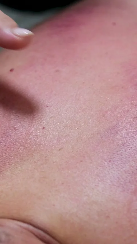 Therapist Heating Suction Cups Using Fire Cupping Stick and Putting Them on Stock Footage 296195053