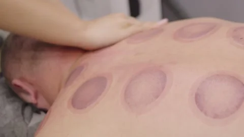 Therapist massaging a man's back with vacuum cup marks Stock-Footage 331460989