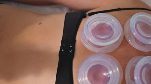 A therapist performs cupping therapy on a person's back to help with muscle Видео 344379261