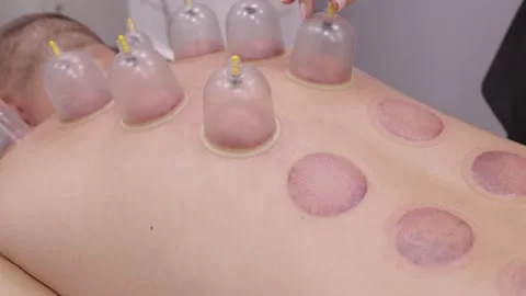 Therapist Removing Vacuum Suction Cups During Cupping Therapy on Patient's Ba Vidéo 344782709